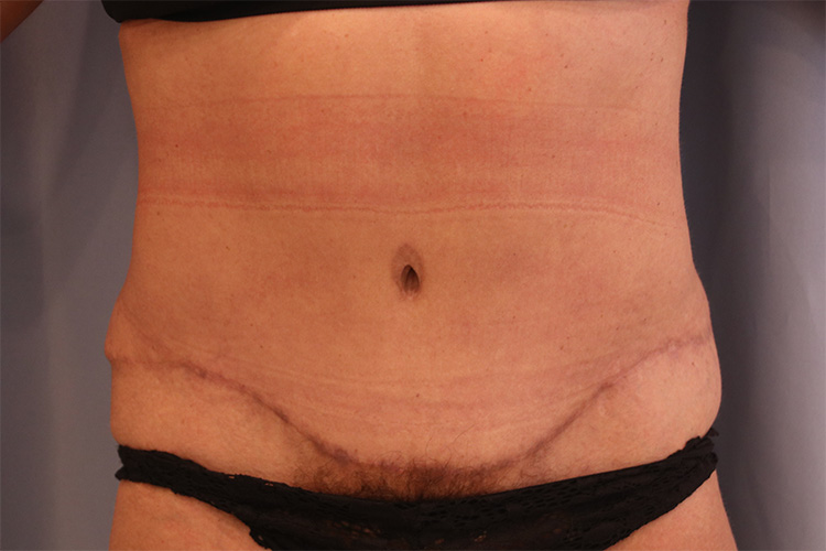 Tummy Tuck Before and After 23