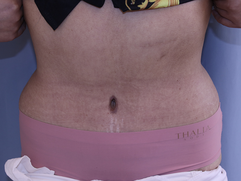 Tummy Tuck Before and After 22