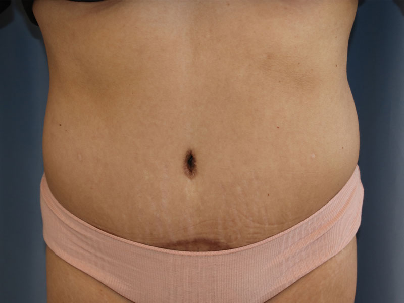 Tummy Tuck Before and After 30
