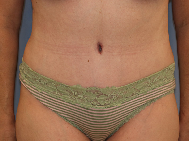 Tummy Tuck Before and After 16