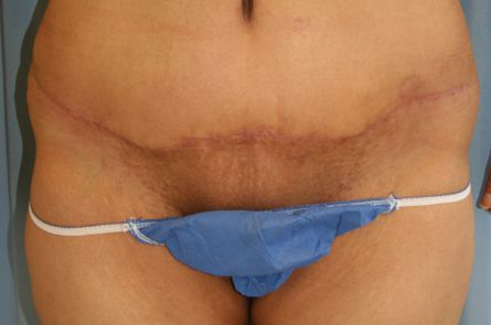 Tummy Tuck Before and After 31