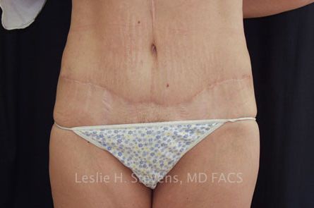 Tummy Tuck Before and After 28