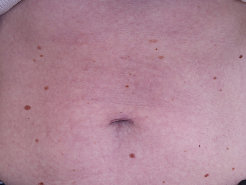 Umbilicoplasty Before and After 16