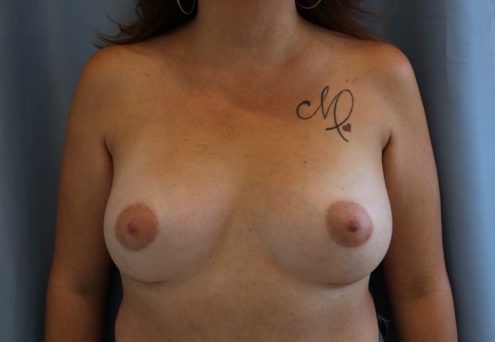 Breast Augmentation Before and After 51