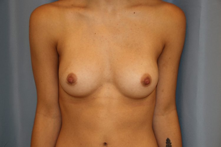 Breast Augmentation Before and After 12