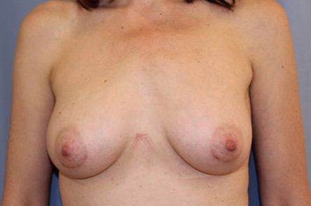 Breast Augmentation Before and After 50