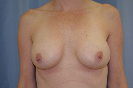 Breast Augmentation Before and After 43