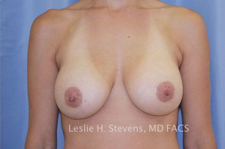 Breast Augmentation Before and After 17