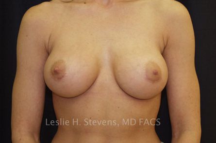 Breast Augmentation Before and After 57