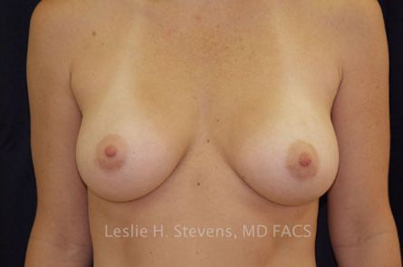 Breast Augmentation Before and After 22