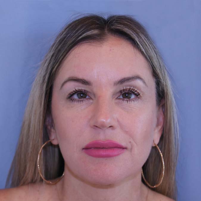 Facelift Before and After 28