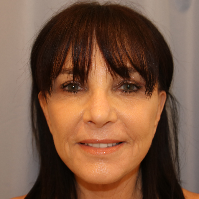 Facelift Before and After 39