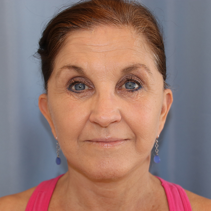 Facelift Before and After 16
