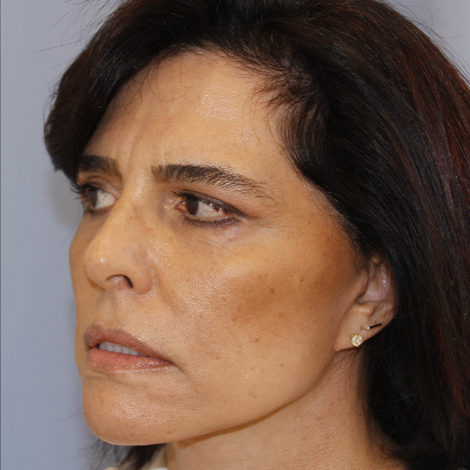 Facelift Before and After 39