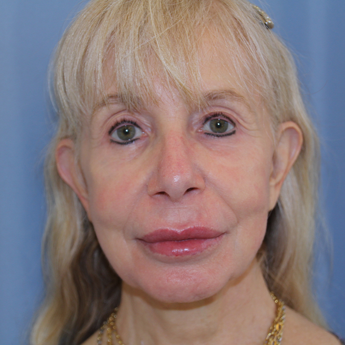 Facelift Before and After 41