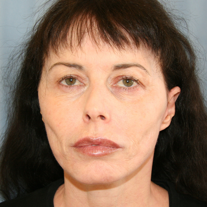 Facelift Before and After 13