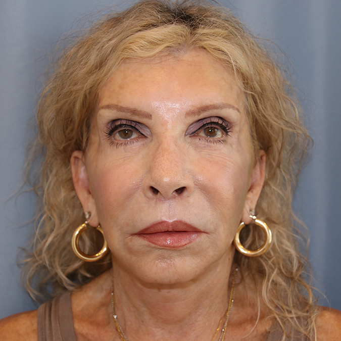 Facelift Before and After 41