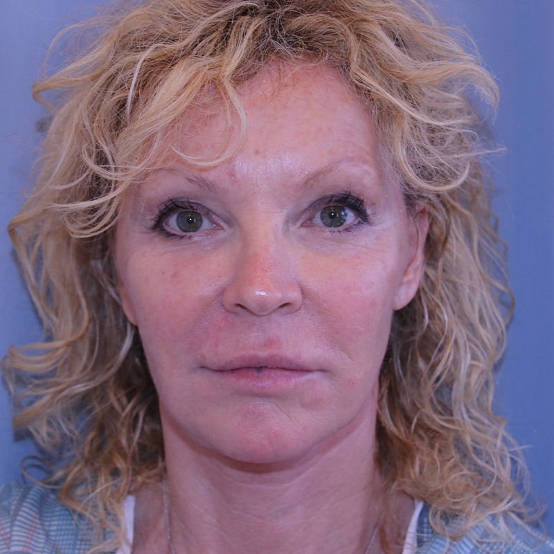 Facelift Before and After 20