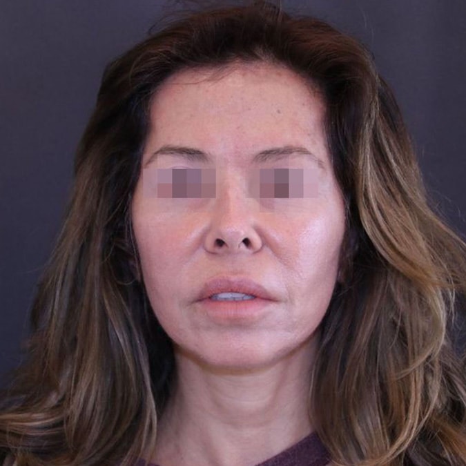 Facelift Before and After 36
