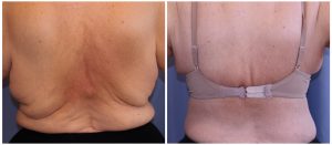 Body Contouring with Bra line Back Lift