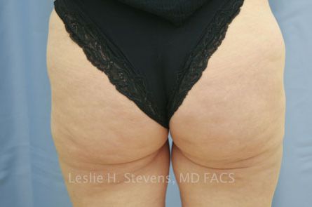 Liposuction Before & After Gallery: Patient 19