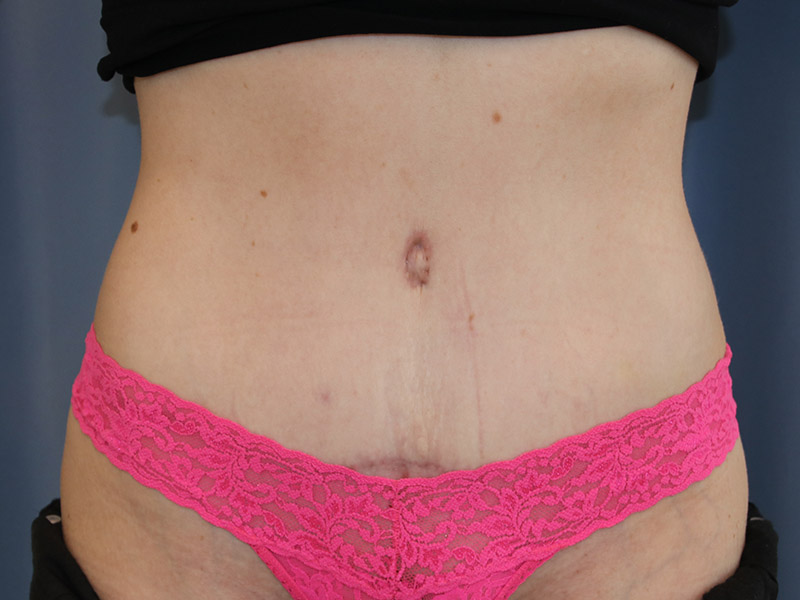 Tummy Tuck Scar Aftercare - Gatineau, QC - Dr. Patricia Berbari