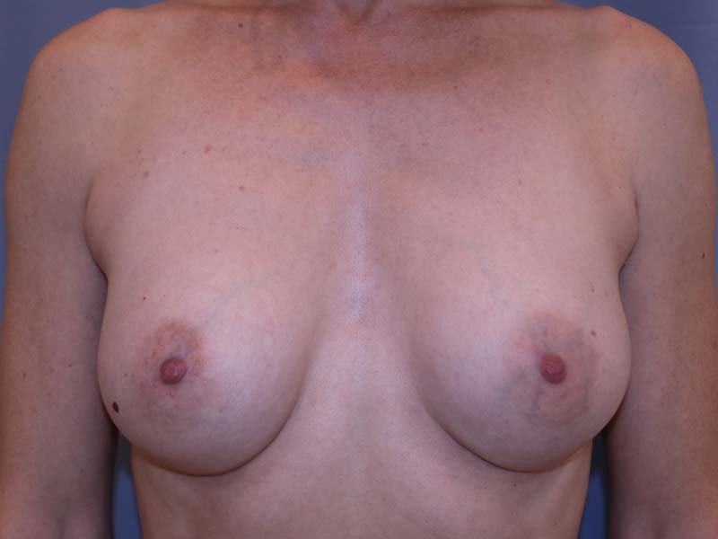 Breast Augmentation Before and After 14