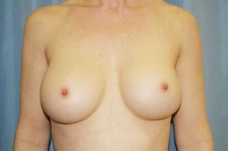 Breast Augmentation Before and After 42