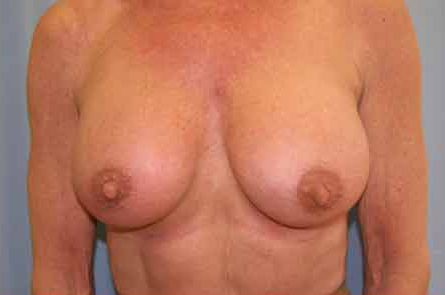 Breast Augmentation Before and After 01