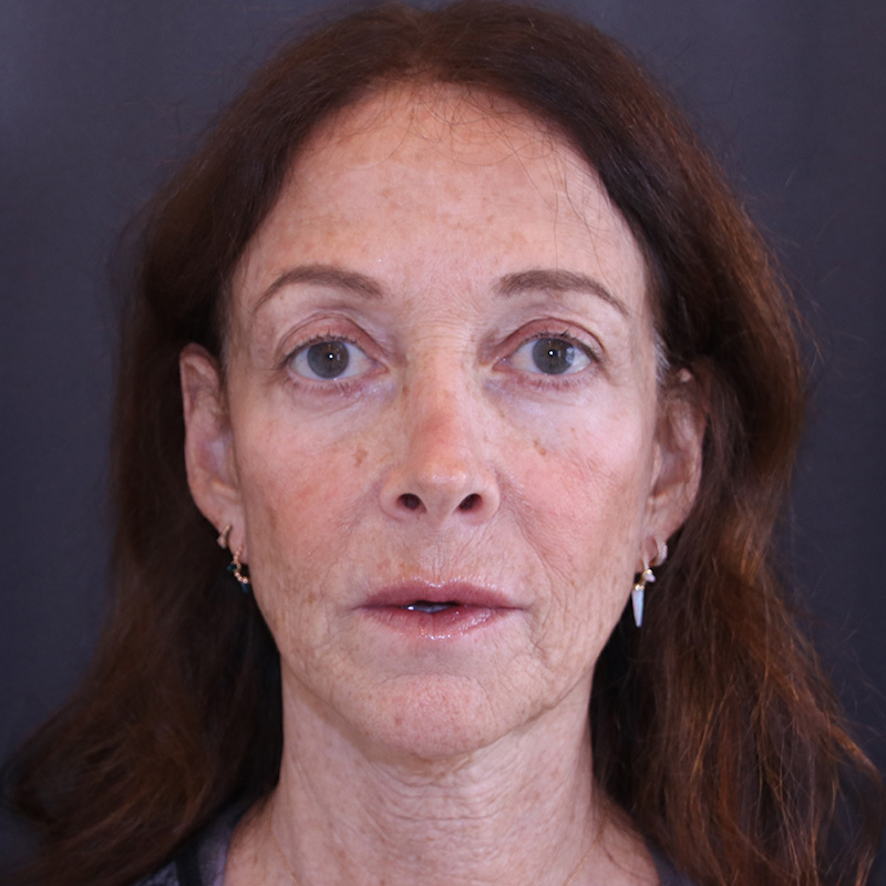 Facelift Before and After 43