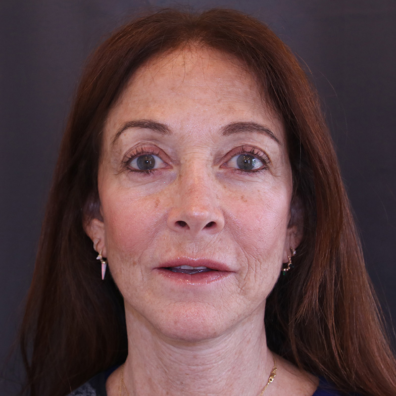 Facelift Before and After | Dr. Leslie Stevens