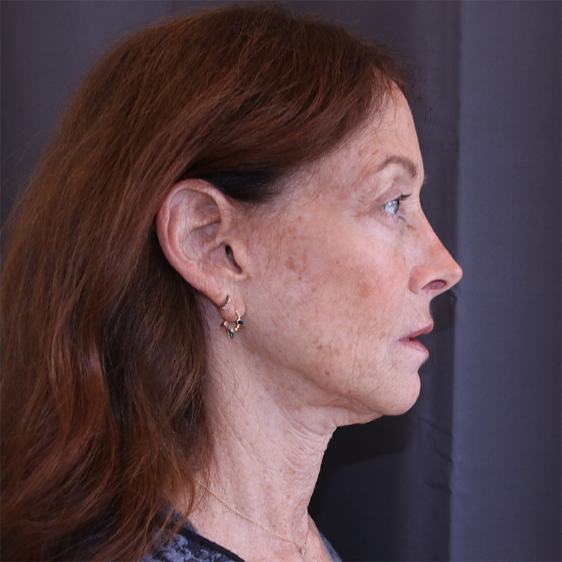 Facelift Before and After 43