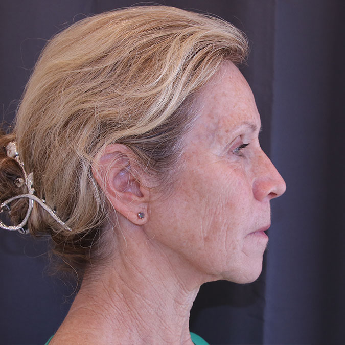 Facelift Before and After 44