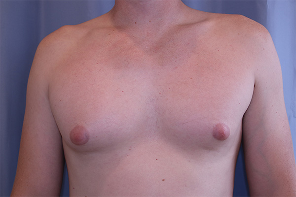 Gynecomastia Before and After 01