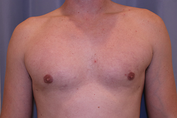 Gynecomastia Before and After | Dr. Leslie Stevens