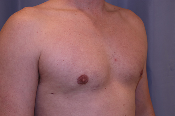 Gynecomastia Before and After 01