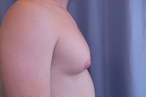 Gynecomastia Before and After 01