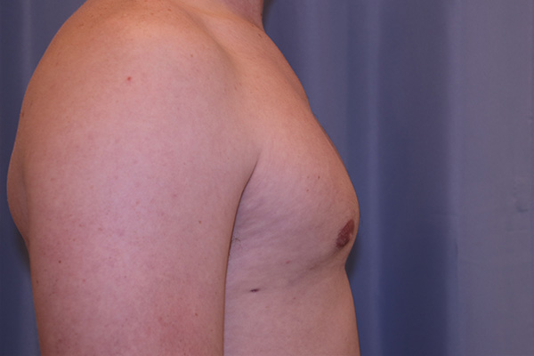 Gynecomastia Before and After 01