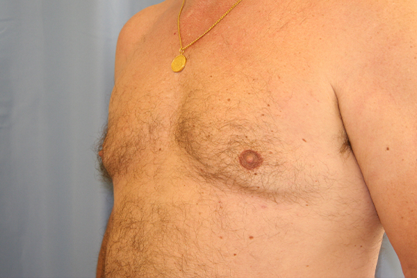 Gynecomastia Before and After 01