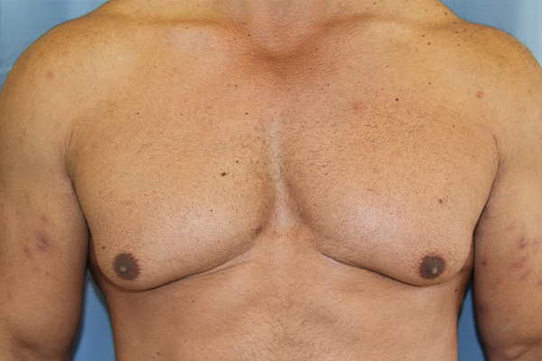 Gynecomastia Before and After 03