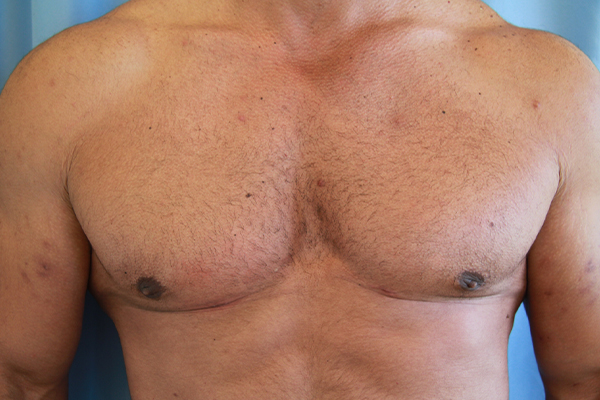 Gynecomastia Before and After 03