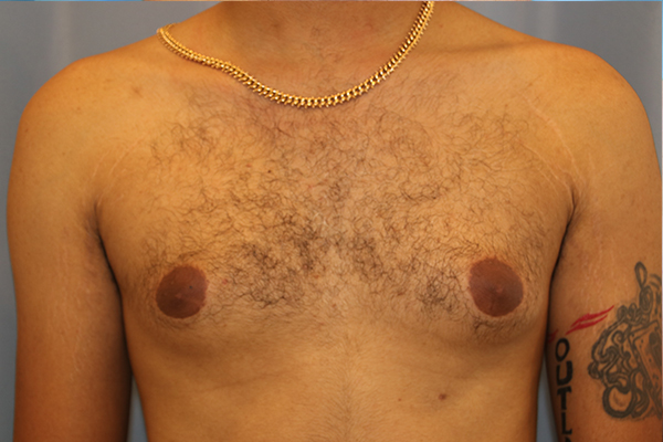 Gynecomastia Before and After 04