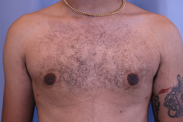 Gynecomastia Before and After 02