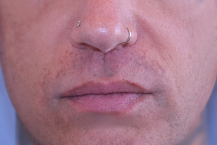 Lip Lift Before and After | Dr. Leslie Stevens