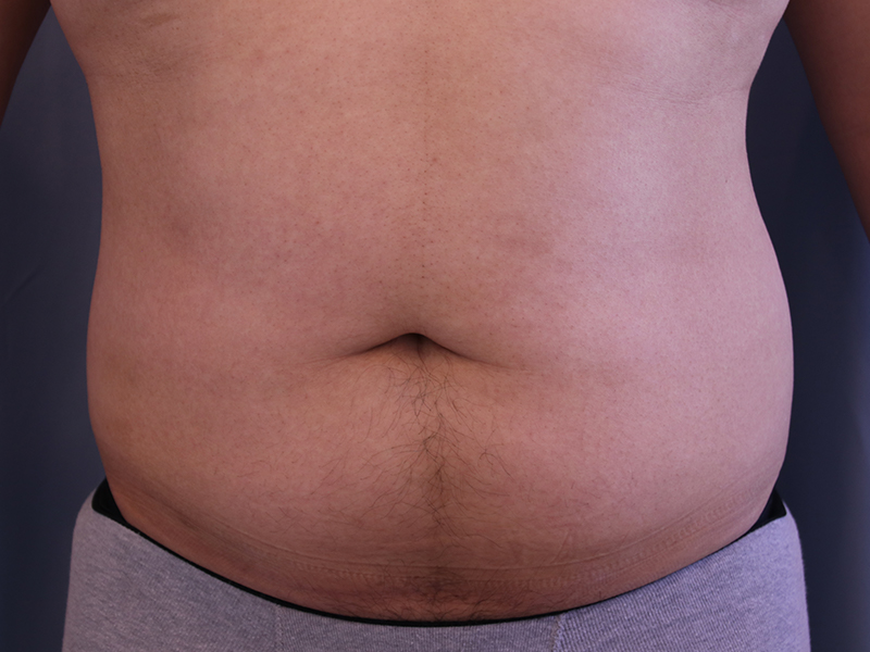 Liposuction Before and After 01