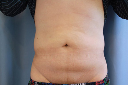 Liposuction Before and After 03