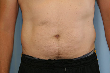 Liposuction Before and After | Dr. Leslie Stevens