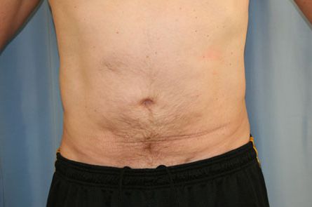 Liposuction Before and After 01