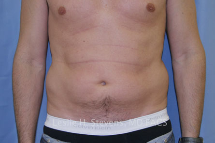 Liposuction Before and After 07