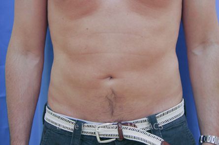 Liposuction Before and After 02